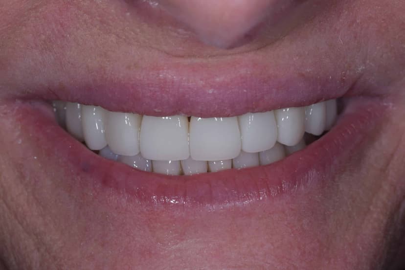 Porcelain Veneers/Crowns