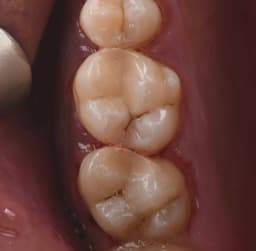 White Fillings