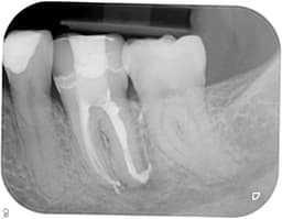 Root Canal Treatment