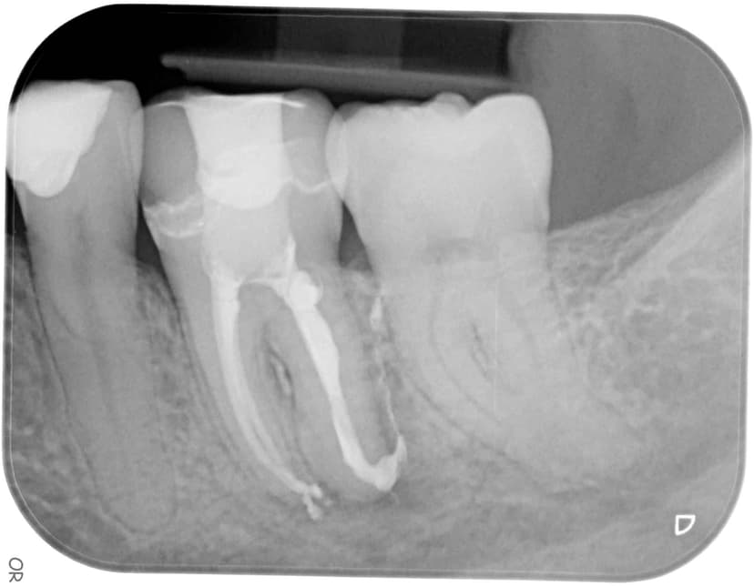 Root Canal Treatment