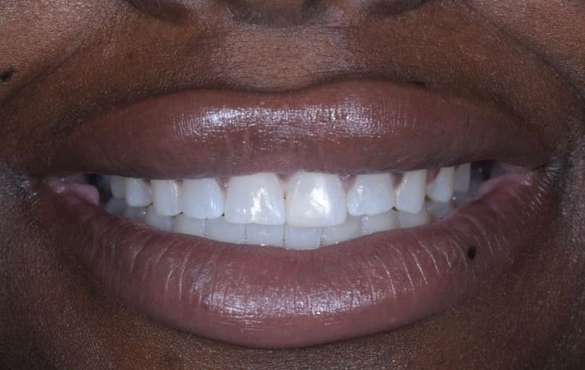 Invisalign