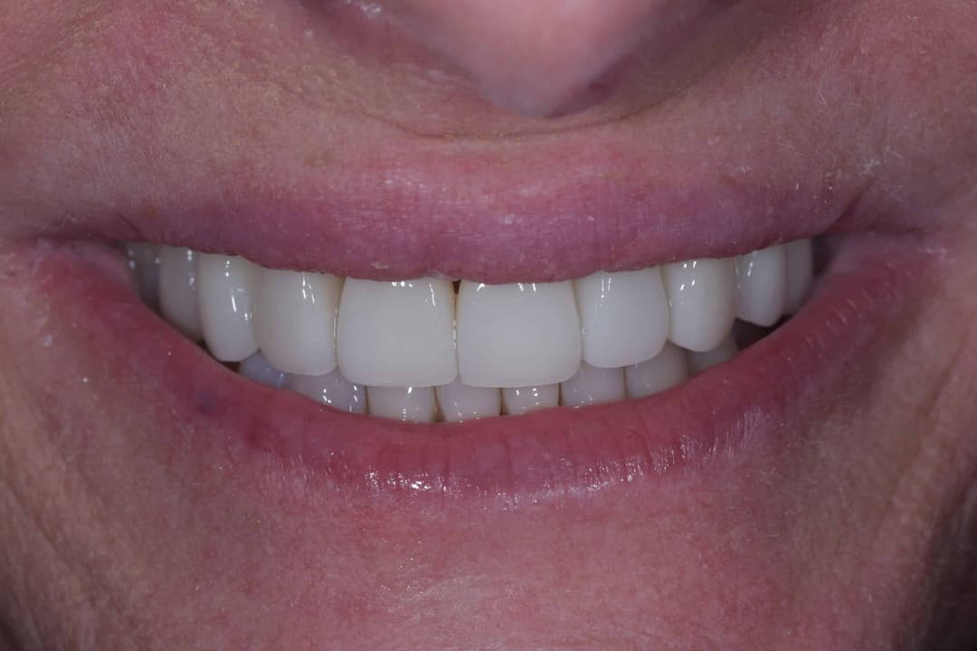 Porcelain Veneers / Crowns